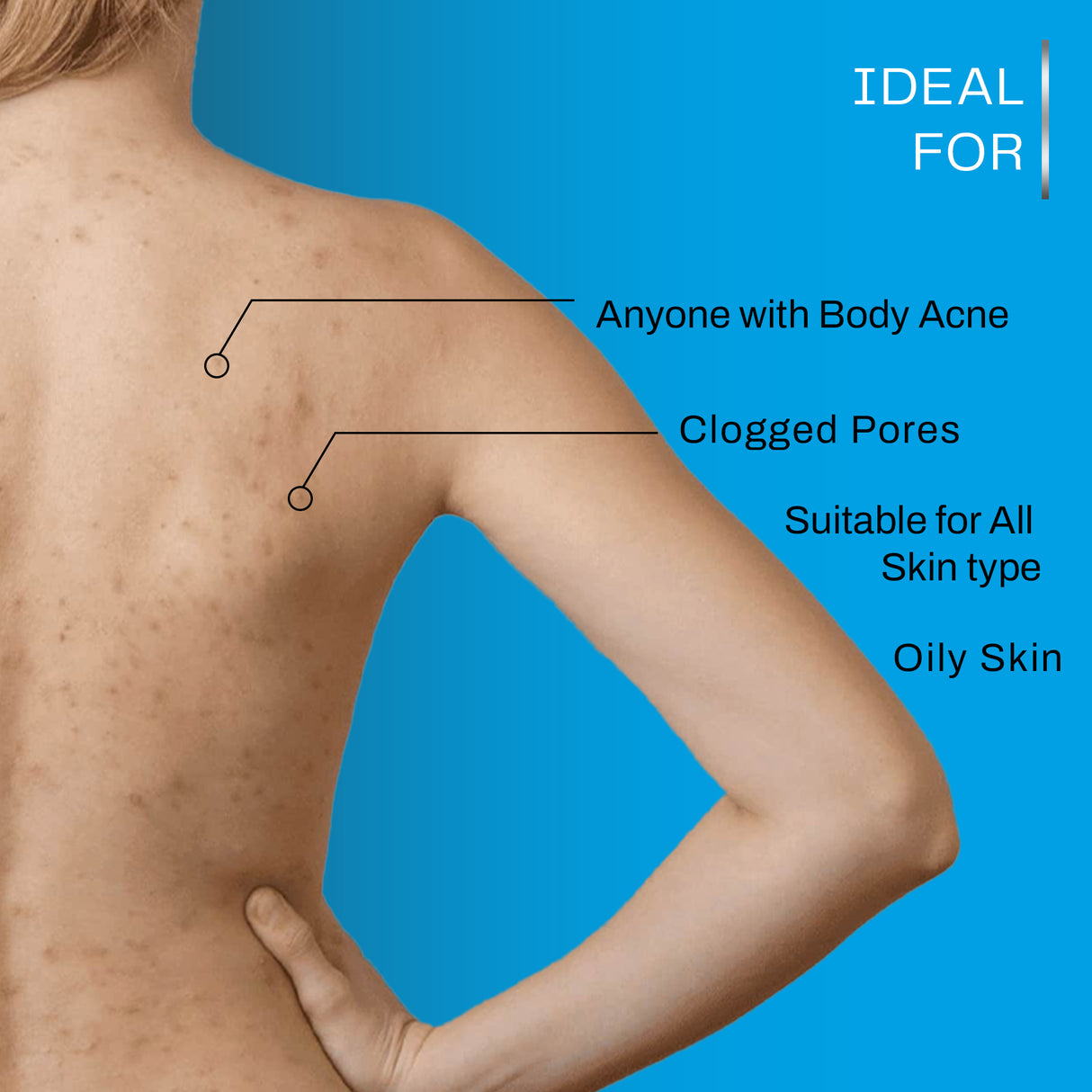 Acne-Causing Impurities