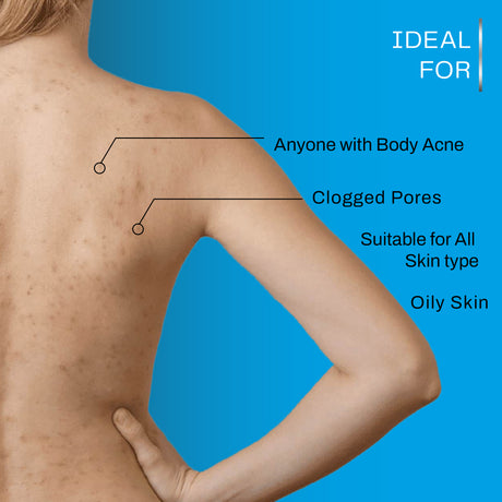 Acne-Causing Impurities