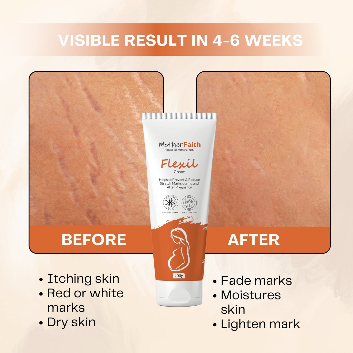 Flexil Cream | Helps to prevent & reduce stretch marks during and after pregnancy  | 100 g